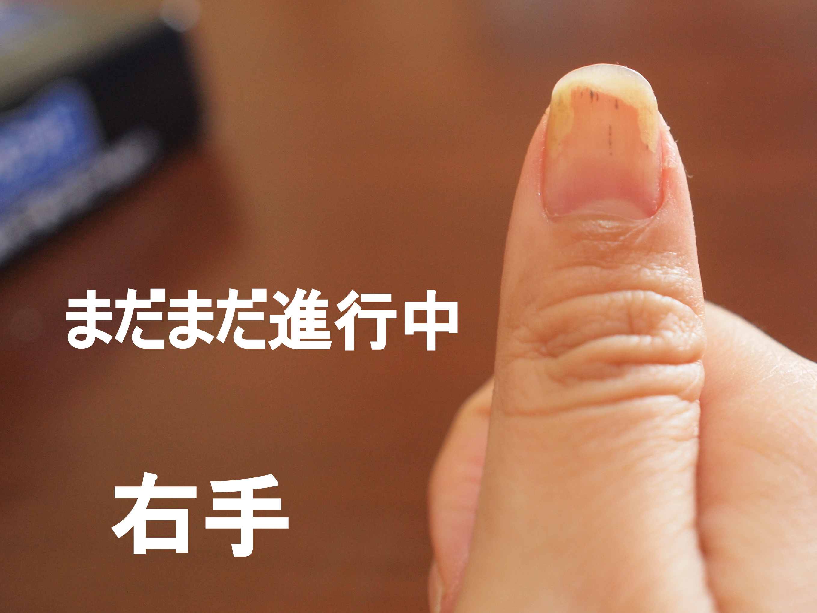 最も人気のある 爪甲剥離症 治る 爪甲剥離症 治るまで Potoapixnanaqy